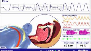 Understanding Sleep Disordered Breathing [upl. by Ahsinelg]