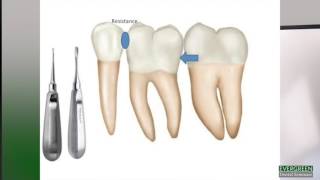 How to make molar extractions easier [upl. by Azeret]