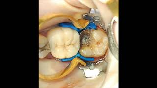 Restoring that broken molar and the difficult class II cavity [upl. by Arimaj]