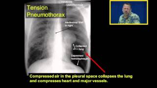 Tension Pneumothorax Introduction to Chest Tubes [upl. by Merc182]