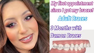 3 MONTH BRACES UPDATE  Damon Braces OverjetOverbite  Adult Braces [upl. by Till165]