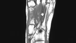 Metatarsal stress fracture by MRI [upl. by Irodim]