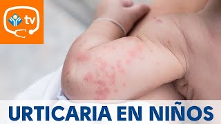 Urticaria en niños ¿cómo se produce ¿Tiene importancia [upl. by Betthel]