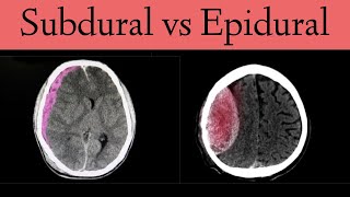 Subdural vs Epidural HematomaHemorrhage CT Scan Findings [upl. by Enaht]