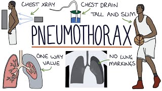 Pneumothorax [upl. by Anastatius]