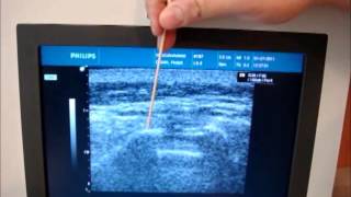 Ultrasound Guided Caudal Epidural Injection [upl. by Notserc]