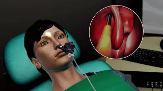 Balloon Sinus Surgery Animation [upl. by Oakie]