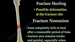 Fracture Healing Part 1  Everything You Need To Know  Dr Nabil Ebraheim [upl. by Hamaso]