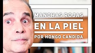 Episodio 1259 Manchas Rojas En La Piel Por Hongo Cándida [upl. by Dunkin900]