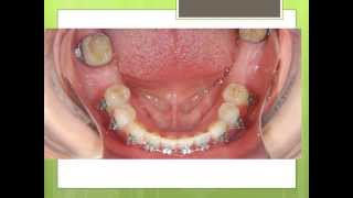 Orthodontics Treatment Before Dental Implants [upl. by Hedwiga]