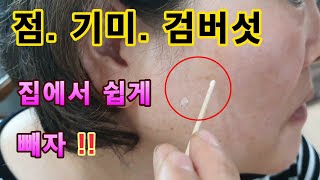 💥💖점 검버섯 기미 제거 집에서 간단하고 쉽게 Mole Black mushrooms Flags Simple and easy to remove at home [upl. by Funk]