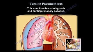 Tension Pneumothorax  Everything You Need To Know  Dr Nabil Ebraheim [upl. by Readus]