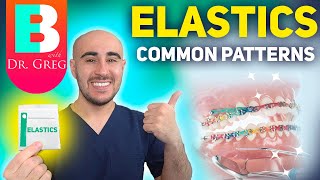 BRACES ELASTICS Most Common Patterns for Braces [upl. by Calley322]