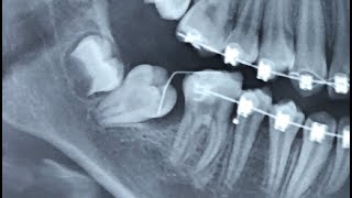 Disimpacting Molars Using The Bach Technique [upl. by Ahseyd485]