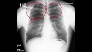 Pneumothorax Radiology in two minutes [upl. by Xenos]