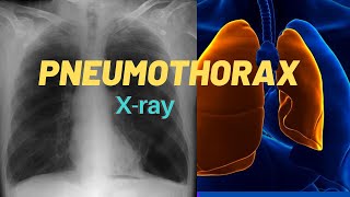 How to identify Pneumothorax in Chest Xray [upl. by Lennad]