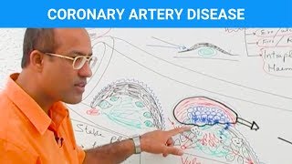 Coronary Artery Disease  Ischemic Heart Disease  Angina🫀 [upl. by Wolfram851]