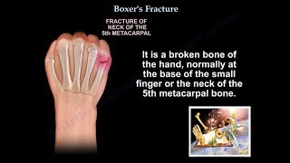 Boxers Fracture  Everything You Need To Know  Dr Nabil Ebraheim [upl. by Ertha]