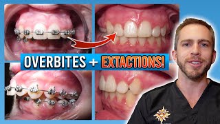 Braces Overbite Treatment BEFORE amp AFTER [upl. by Remled]