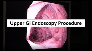 Upper GI Endoscopy Procedure in the ED [upl. by Ydniw]