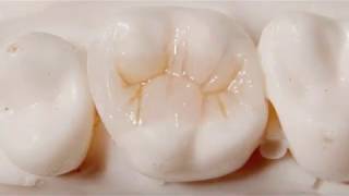 Upper First Molar Composite buildup step by step [upl. by Ziagos]