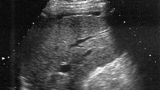 Cirrosis hepática en imagen TC Eco RM [upl. by Blackburn11]