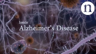 Alzheimers Disease Pathophysiology Rapid Review [upl. by Ailices]